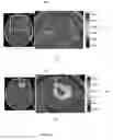 Fig. 09 - Quantifying mass effect deformation with structural radiomics in brain tumor patients