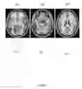 Fig. 10 - Quantifying mass effect deformation with structural radiomics in brain tumor patients