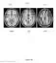 Fig. 11 - Quantifying mass effect deformation with structural radiomics in brain tumor patients