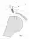 Fig. 02 - Fixation unit and handling device for a suture-less fixation of tissue