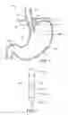 Fig. 02 - Connected fasteners, delivery device and method