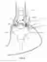 Fig. 05 - Connected fasteners, delivery device and method