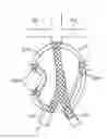 Fig. 01 - Stent graft delivery system