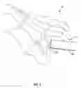 Fig. 06 - Systems and methods for implanting surgical implants