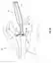 Fig. 09 - Systems and methods for implanting surgical implants