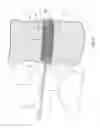 Fig. 09 - ENDOSCOPIC INFLATABLE ABRADING DEVICE FOR SPINAL DISC REMOVAL