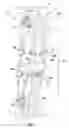 Fig. 02 - Spinal correction system actuators