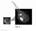 Fig. 07 - DEVICE AND METHOD FOR ASSISTING IN TISSUE ABLATION