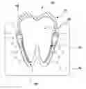 Fig. 01 - IMPLANTABLE REPLICA OF NATURAL TOOTH