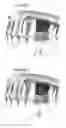 Fig. 02 - SINUS LIFT PROCEDURE AND SIDECUTTING DRILL