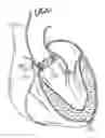 Fig. 01 - Retaining mechanisms for prosthetic valves