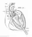 Fig. 08 - Retaining mechanisms for prosthetic valves