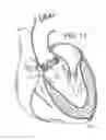 Fig. 10 - Retaining mechanisms for prosthetic valves