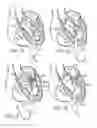 Fig. 15 - Retaining mechanisms for prosthetic valves