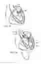 Fig. 16 - Retaining mechanisms for prosthetic valves