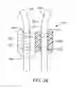 Fig. 20 - Retaining mechanisms for prosthetic valves
