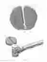 Fig. 08 - Vertebral implants and methods for installation thereof