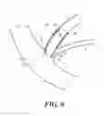 Fig. 07 - Stent