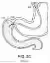 Fig. 06 - DEVICES AND METHODS FOR PLACING A GASTROINTESTINAL DEVICE
