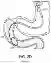 Fig. 07 - DEVICES AND METHODS FOR PLACING A GASTROINTESTINAL DEVICE