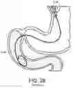 Fig. 08 - DEVICES AND METHODS FOR PLACING A GASTROINTESTINAL DEVICE