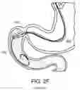 Fig. 09 - DEVICES AND METHODS FOR PLACING A GASTROINTESTINAL DEVICE