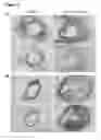 Fig. 07 - Aortopathy