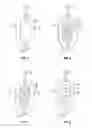 Fig. 03 - Intracavity balloon catheter and method of use