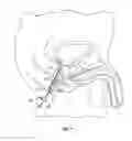 Fig. 04 - Intracavity balloon catheter and method of use