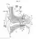 Fig. 02 - Distributed implantable hearing systems