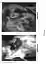 Fig. 10 - Compositions and methods for treating fatty tissue buildup