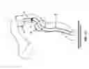 Fig. 85 - Method and apparatus for manipulating the side wall of a body lumen or body cavity so as to provide increased visualization of the same and/or increased access to the same, and/or for stabilizing instruments relative to the same