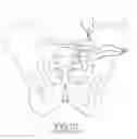Fig. 04 - Systems for and methods of diagnosing and treating a sacroiliac joint disorder