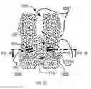 Fig. 63 - Systems for and methods of diagnosing and treating a sacroiliac joint disorder