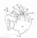 Fig. 79 - Systems for and methods of diagnosing and treating a sacroiliac joint disorder