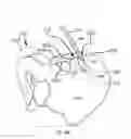 Fig. 80 - Systems for and methods of diagnosing and treating a sacroiliac joint disorder