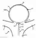 Fig. 01 - Electrolytic and mechanical detachment for implant delivery systems