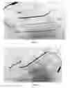 Fig. 02 - SYSTEMS AND METHODS FOR ELECTRODE PLACEMENT IN DEEP MUSCLES AND NERVES USING ULTRASOUND GUIDANCE