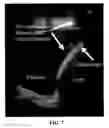 Fig. 04 - SYSTEMS AND METHODS FOR ELECTRODE PLACEMENT IN DEEP MUSCLES AND NERVES USING ULTRASOUND GUIDANCE