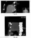 Fig. 06 - SYSTEMS AND METHODS FOR ELECTRODE PLACEMENT IN DEEP MUSCLES AND NERVES USING ULTRASOUND GUIDANCE