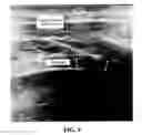 Fig. 07 - SYSTEMS AND METHODS FOR ELECTRODE PLACEMENT IN DEEP MUSCLES AND NERVES USING ULTRASOUND GUIDANCE