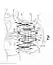 Fig. 02 - Flexible maxillo-mandibular fixation device