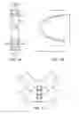Fig. 02 - Dynamized interspinal implant