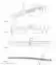 Fig. 02 - Bone plate system with inserts for contacting an adjacent bone surface
