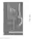 Fig. 34 - Methods and apparatuses for remodeling tissue of or adjacent to a body passage