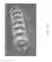 Fig. 35 - Methods and apparatuses for remodeling tissue of or adjacent to a body passage