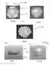 Fig. 09 - Patella implant planning