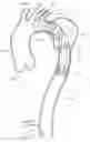 Fig. 01 - Endograft for treating branched vessels