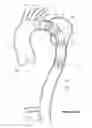Fig. 08 - Endograft for treating branched vessels