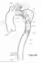 Fig. 09 - Endograft for treating branched vessels